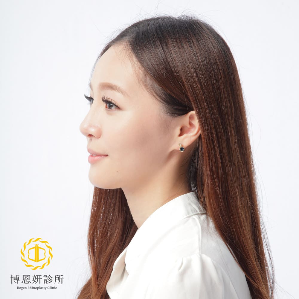 台北隆鼻手術,博恩妍診所女性鼻整形手術價格